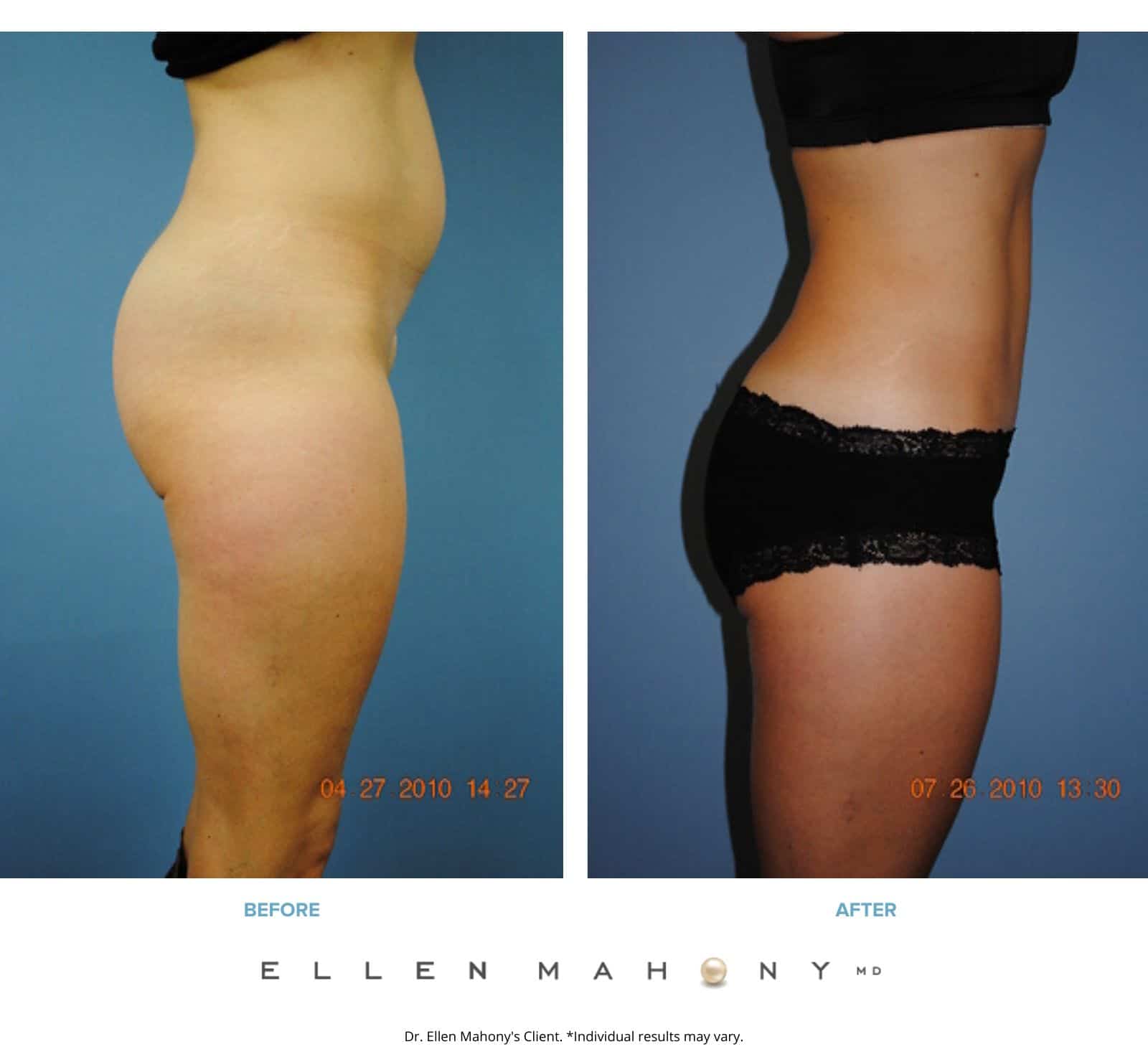 Mini Tummy Tuck | Westport CT | Dr. Ellen Mahony