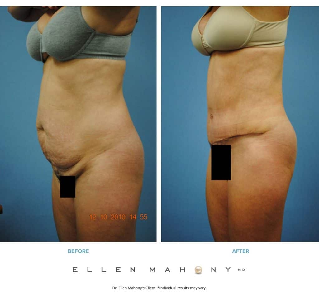 Tummy Tuck | Westport CT | Dr. Ellen Mahony