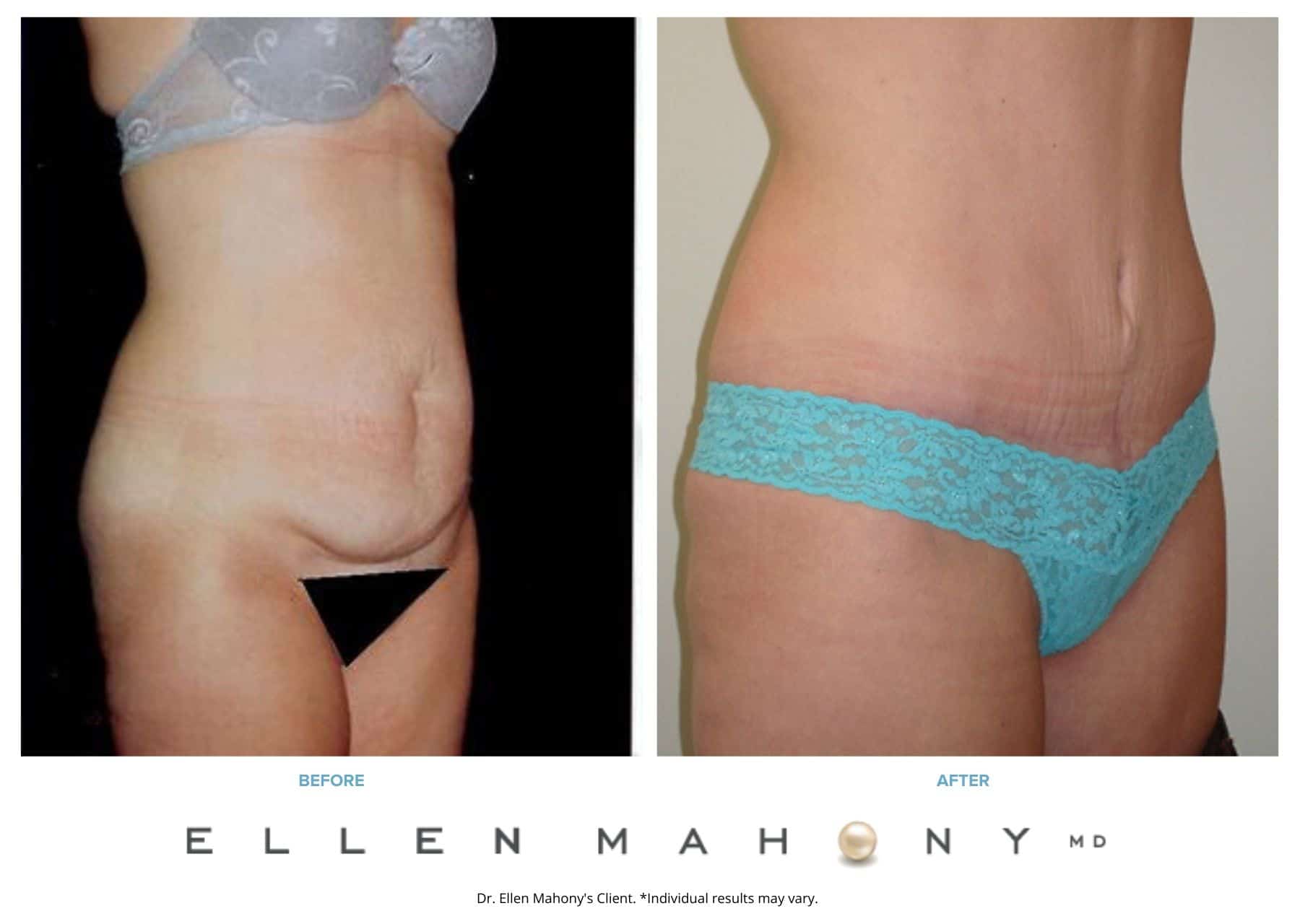 Vertical Scar Tummy Tuck | Westport CT | Dr. Ellen Mahony