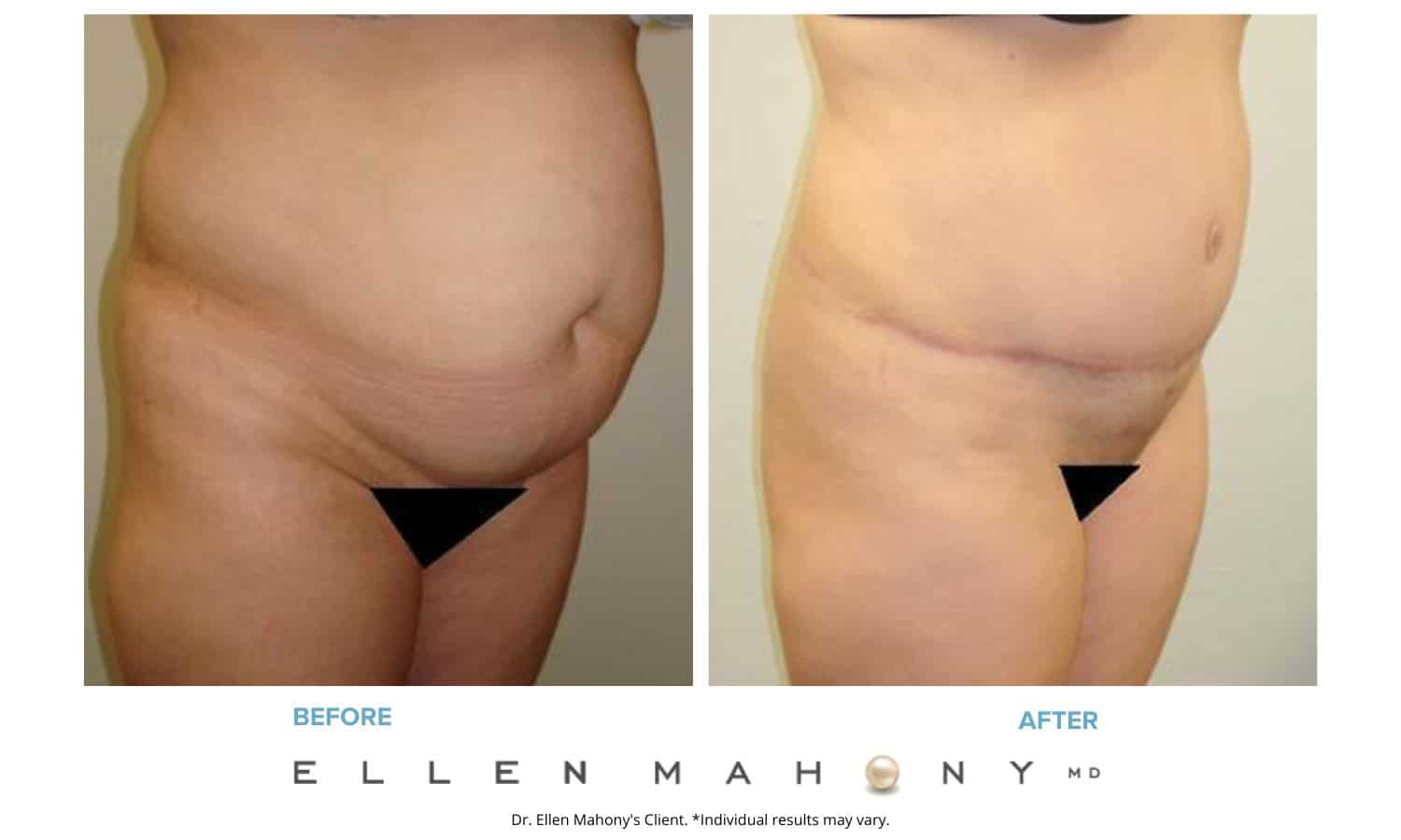 Tummy Tuck | Westport CT | Dr. Ellen Mahony