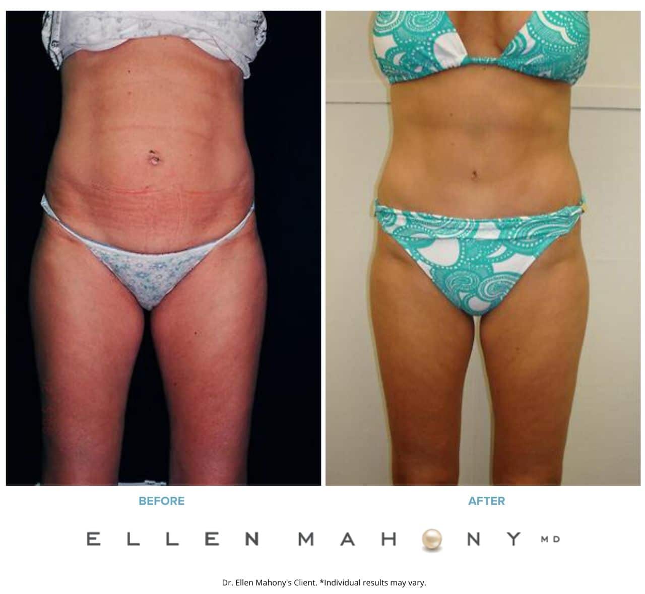 Tummy Tuck | Westport CT | Dr. Ellen Mahony