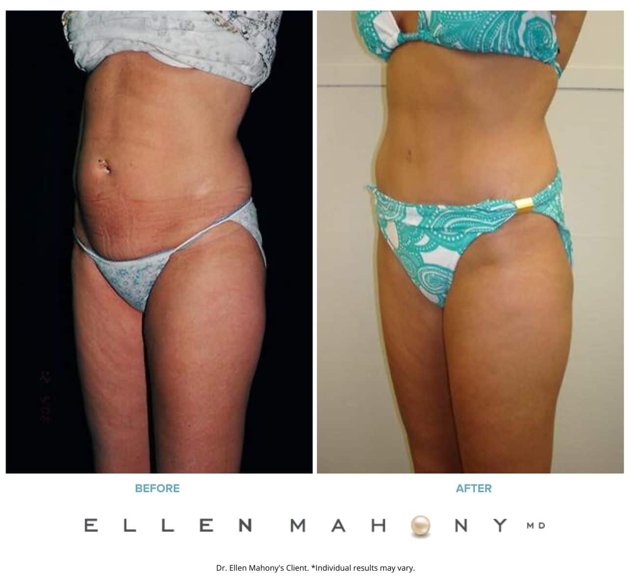 Tummy Tuck | Westport CT | Dr. Ellen Mahony