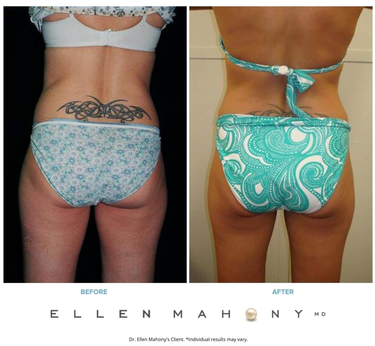 Tummy Tuck | Westport CT | Dr. Ellen Mahony