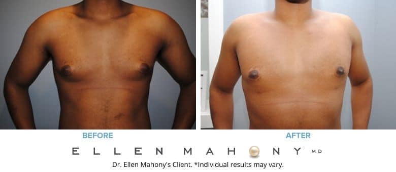 Male Breast Reduction Westport CT | Dr. Ellen Mahony