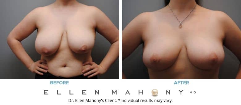 Breast Reduction Westport CT | Dr. Ellen Mahony