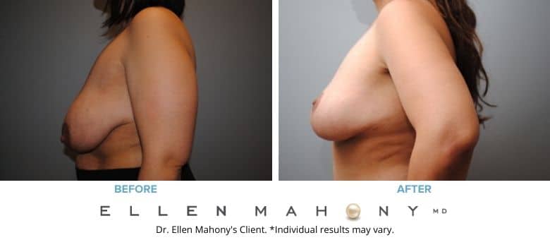 Breast Reduction Westport CT | Dr. Ellen Mahony