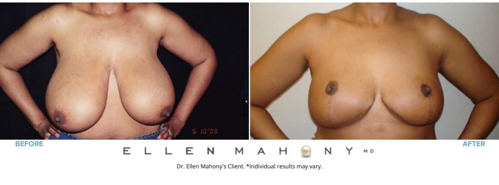 Breast Reduction Westport CT | Dr. Ellen Mahony