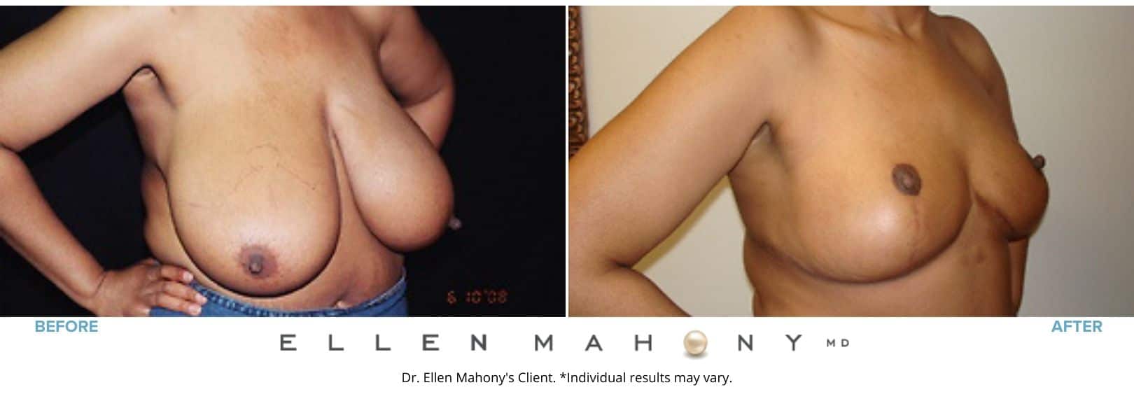 Breast Reduction Westport CT | Dr. Ellen Mahony