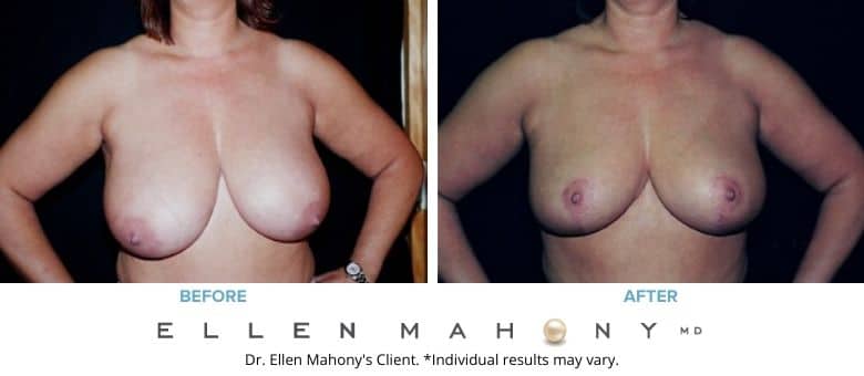 Breast Reduction Westport CT | Dr. Ellen Mahony