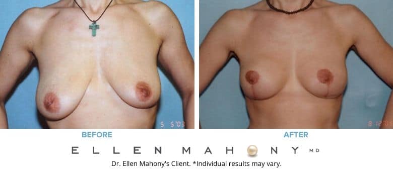 Breast Reduction Westport CT | Dr. Ellen Mahony