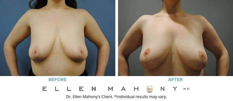 Breast Lift | Westport CT | Dr. Ellen Mahony