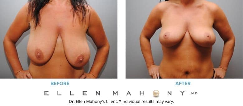 Breast Lift Before & After Images Westport CT