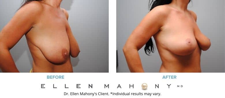 Breast Lift | Westport CT | Dr. Ellen Mahony