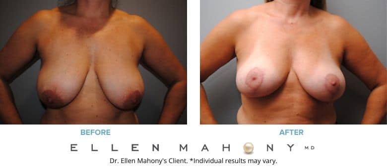 Breast Lift | Westport CT | Dr. Ellen Mahony