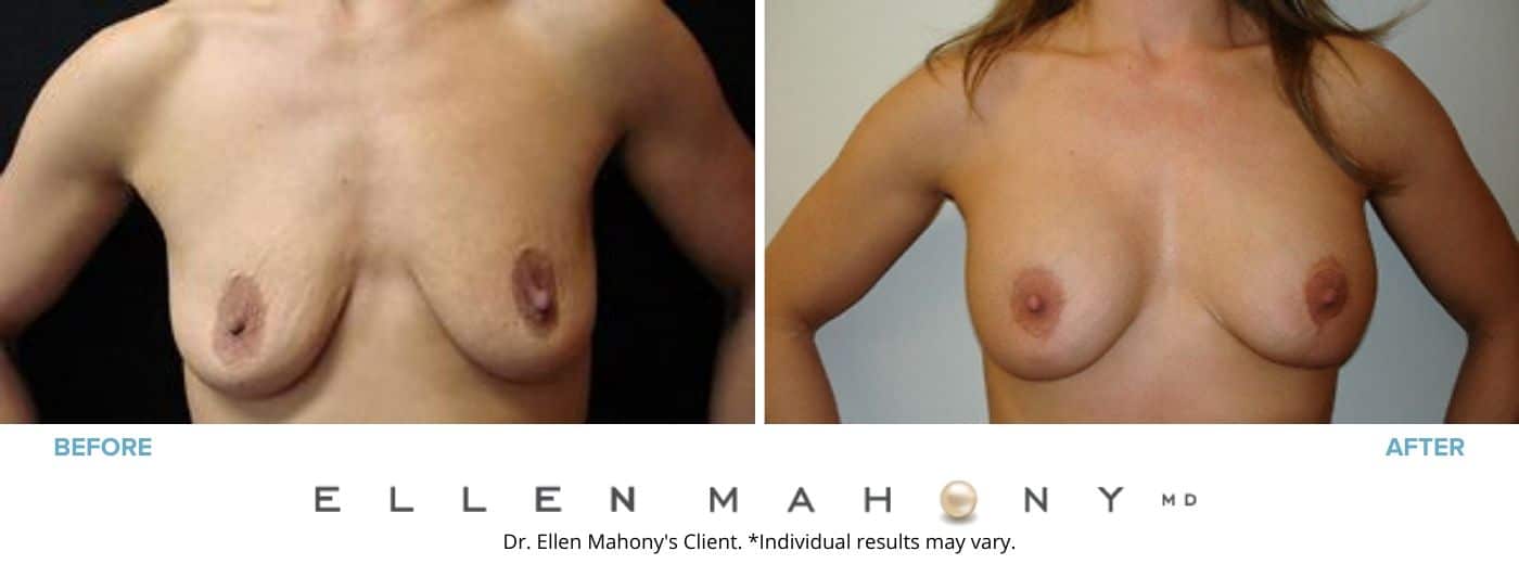 Breast Lift Westport CT | Dr. Ellen Mahony