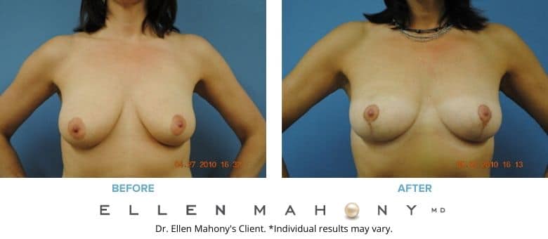 Breast Lift Westport CT | Dr. Ellen Mahony