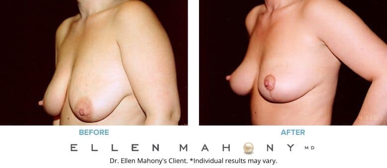 Breast Lift Westport CT | Dr. Ellen Mahony