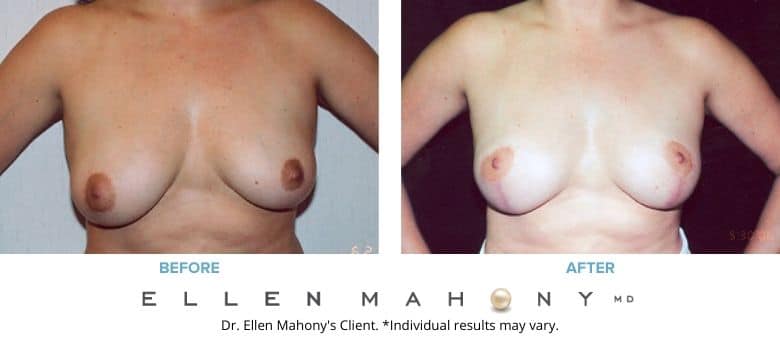 Breast Lift Westport CT | Dr. Ellen Mahony