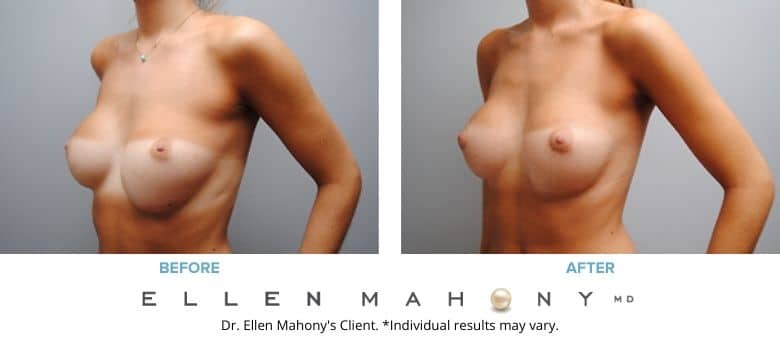 Corrective Breast Surgery Westport CT | Dr. Ellen Mahony