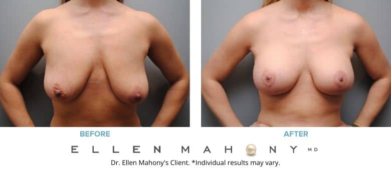 Breast Augmentation and Lift Westport CT | Dr. Ellen Mahony