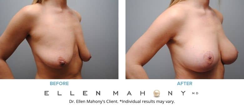 Breast Augmentation and Lift Westport CT | Dr. Ellen Mahony