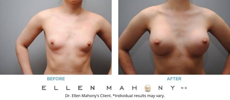 Breast Augmentation Westport CT | Dr. Ellen Mahony