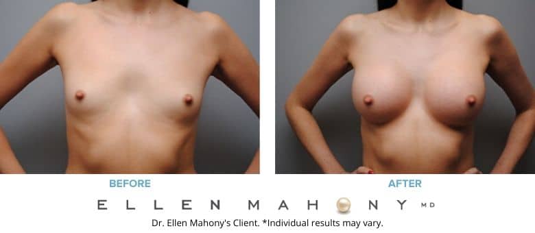 Breast Augmentation Westport CT | Dr. Ellen Mahony