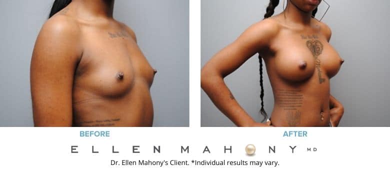 Breast Augmentation Westport CT | Dr. Ellen Mahony