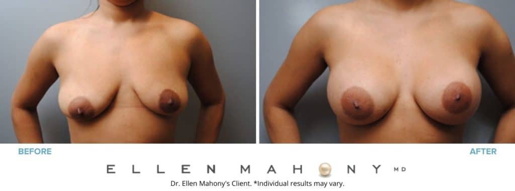 Corrective Breast Surgery – Asymmetry | Westport CT | Dr. Ellen Mahony