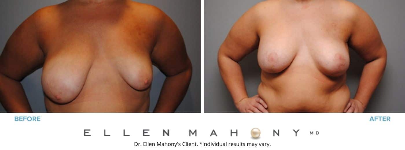 Breast Augmentation and Lift Westport CT | Dr. Ellen Mahony