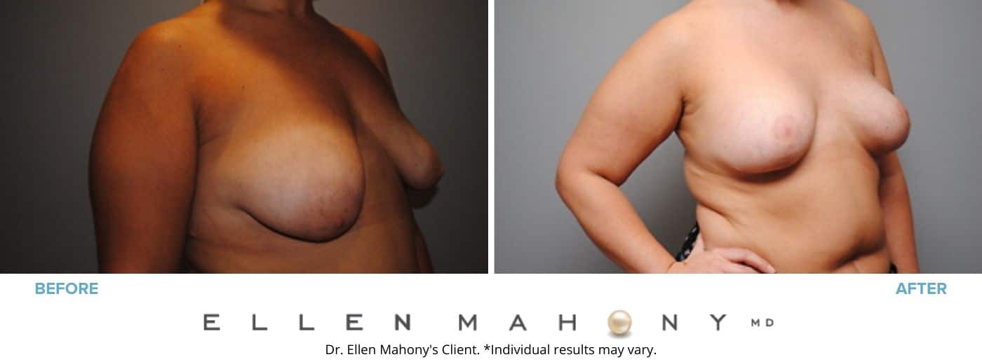 Breast Augmentation and Lift Westport CT | Dr. Ellen Mahony