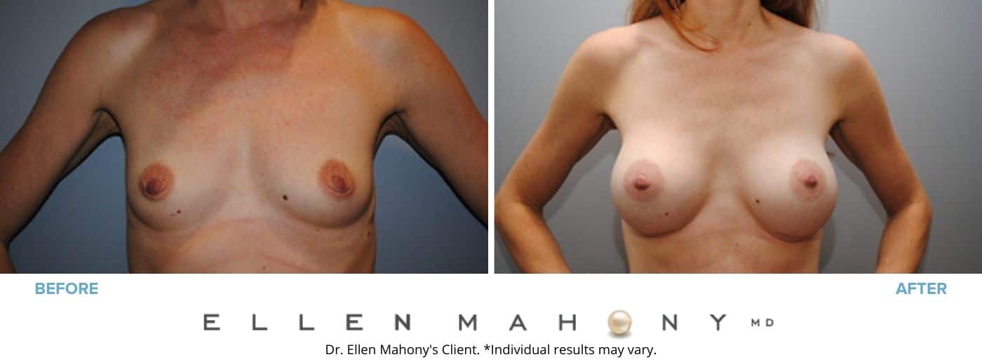 Breast Augmentation | Westport CT | Dr. Ellen Mahony