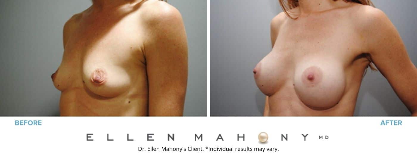 Breast Augmentation | Westport CT | Dr. Ellen Mahony