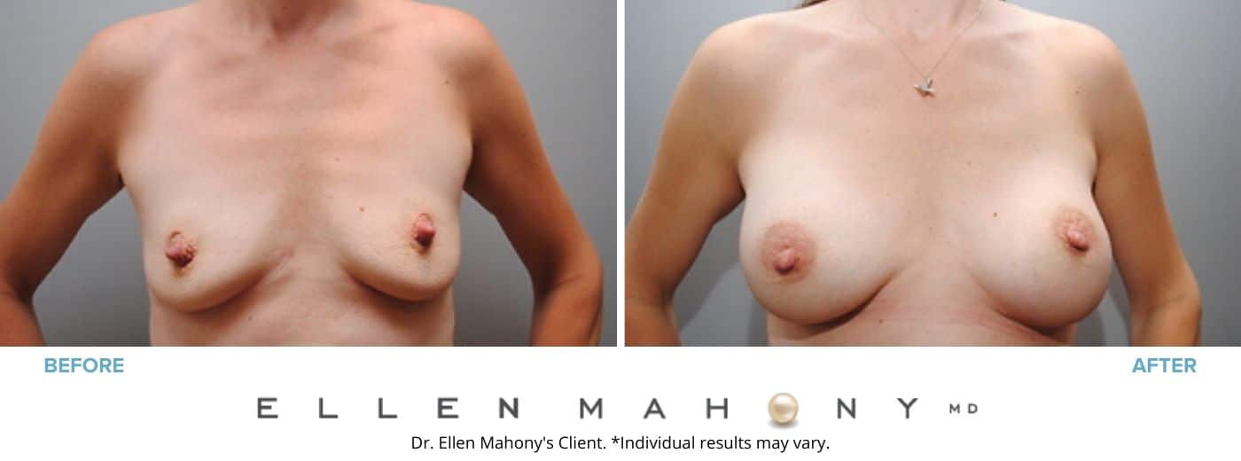 Breast Augmentation | Westport CT | Dr. Ellen Mahony