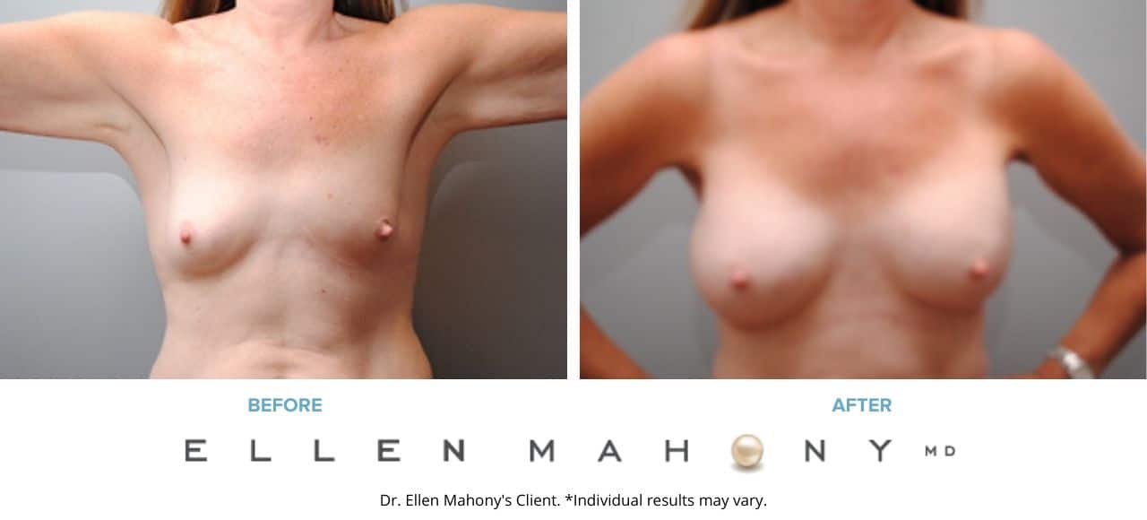 Breast Augmentation | Westport CT | Dr. Ellen Mahony