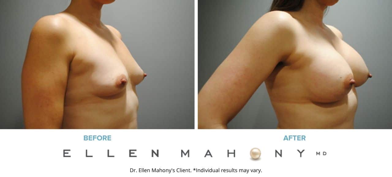 Breast Augmentation | Westport CT | Dr. Ellen Mahony