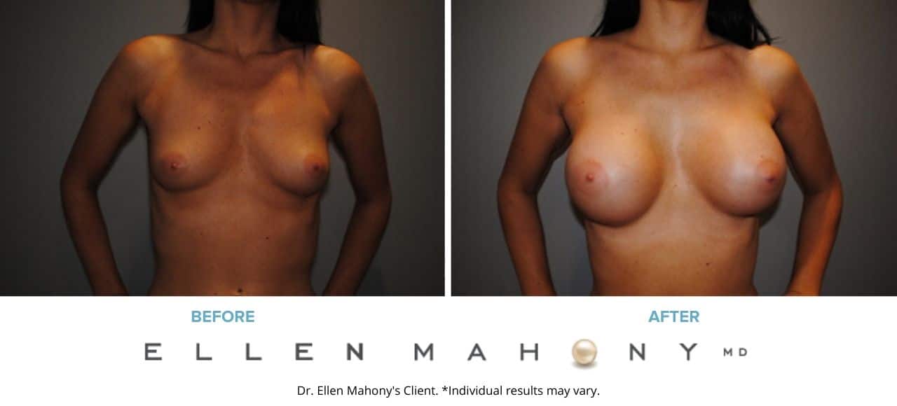 Breast Augmentation | Westport CT | Dr. Ellen Mahony