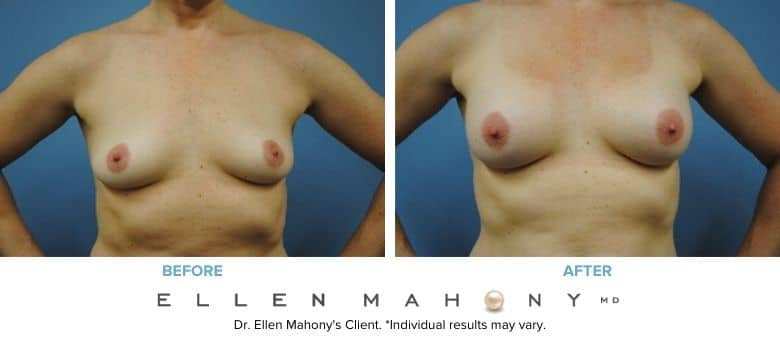 Breast Augmentation | Westport CT | Dr. Ellen Mahony