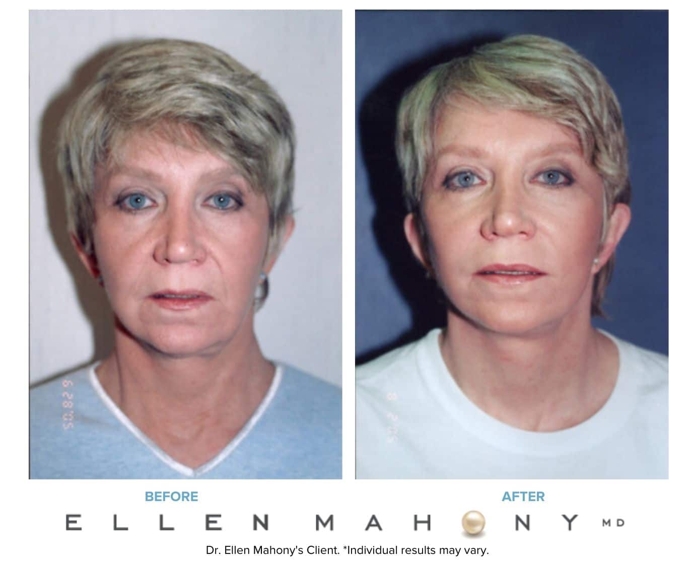 Facial Augmentation Surgery Before & After Images Westport CT