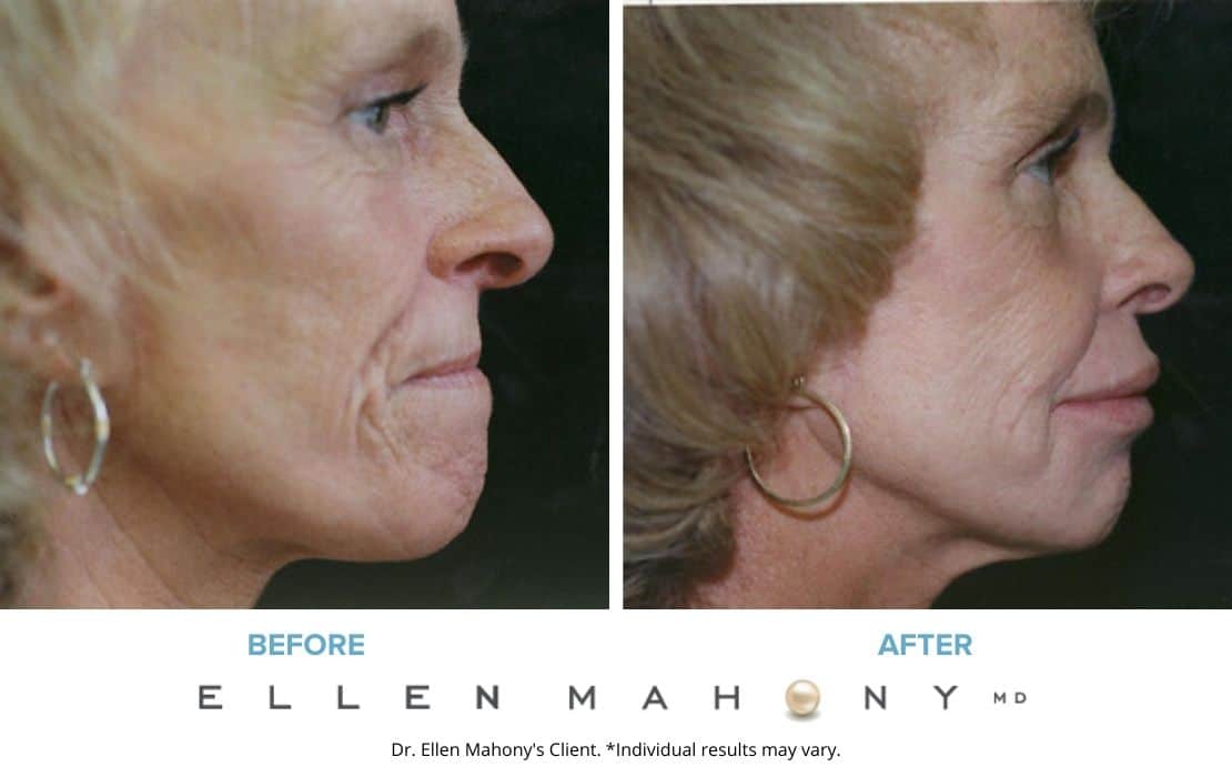 Facial Augmentation | Westport CT | Dr. Ellen Mahony