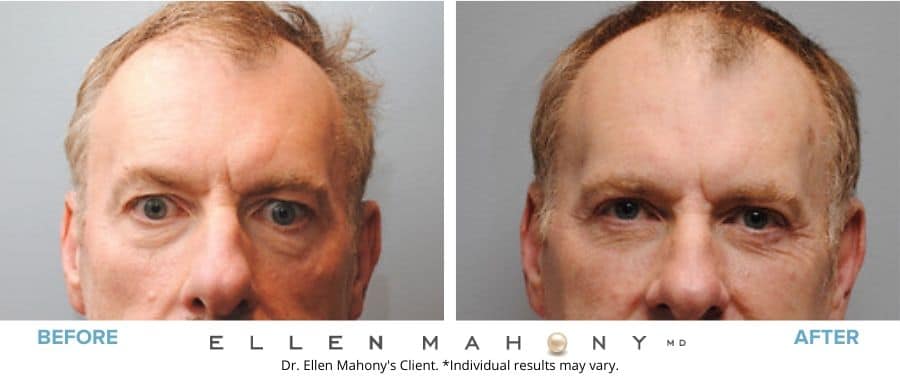 Eyelid Surgery for Men Westport CT | Dr. Ellen Mahony