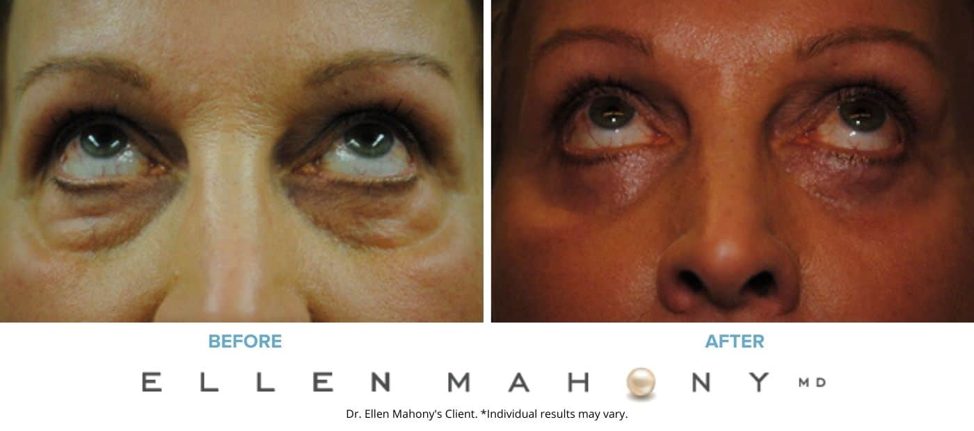 Eyelid Surgery | Westport CT | Dr. Ellen Mahony