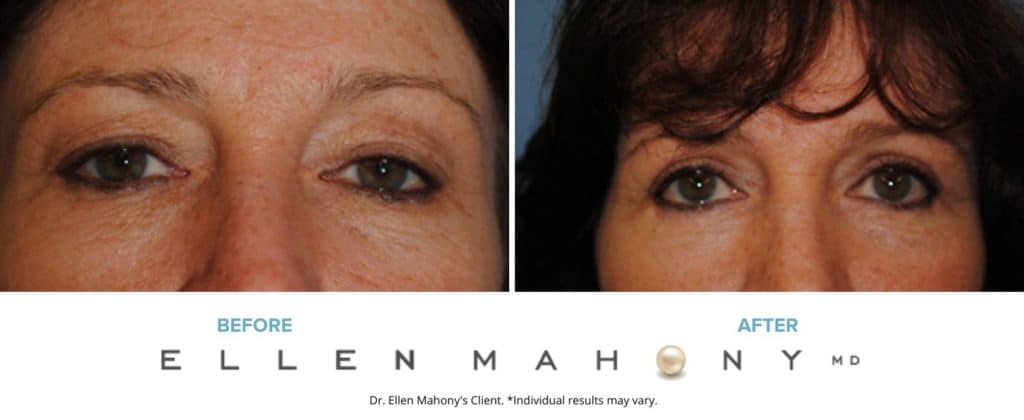 Eyelid Surgery | Westport CT | Dr. Ellen Mahony