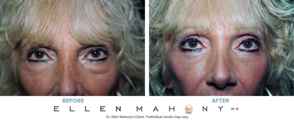 Eyelid Surgery | Westport CT | Dr. Ellen Mahony