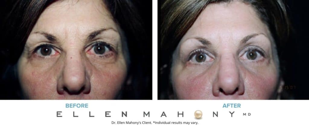 Eyelid Surgery | Westport CT | Dr. Ellen Mahony