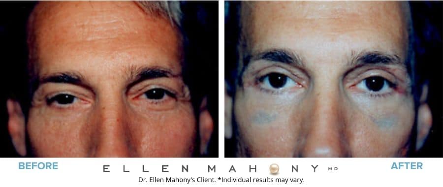 Eyelid Surgery for Men Westport CT | Dr. Ellen Mahony