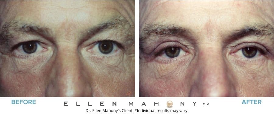 Eyelid Surgery for Men Westport CT | Dr. Ellen Mahony