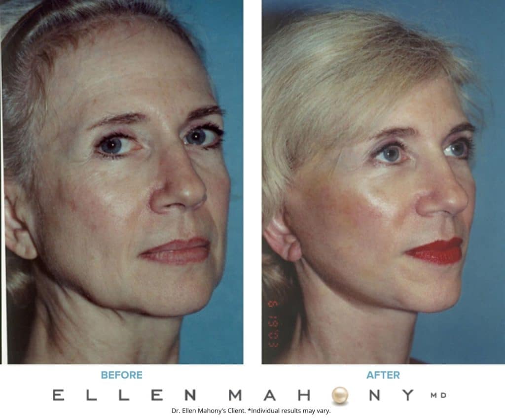 Face Lift/Neck Lift | Westport CT | Dr. Ellen Mahony