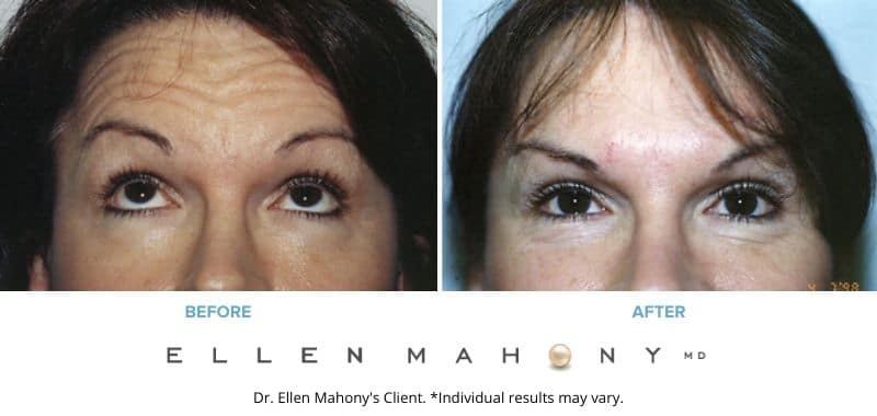 Botox & Dysport Before & After Images Fairfield County CT