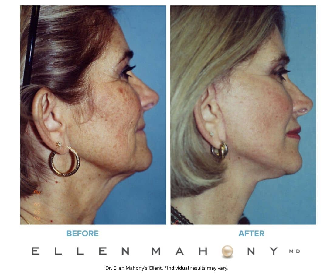 Skin Resurfacing | Westport CT | Dr. Ellen Mahony